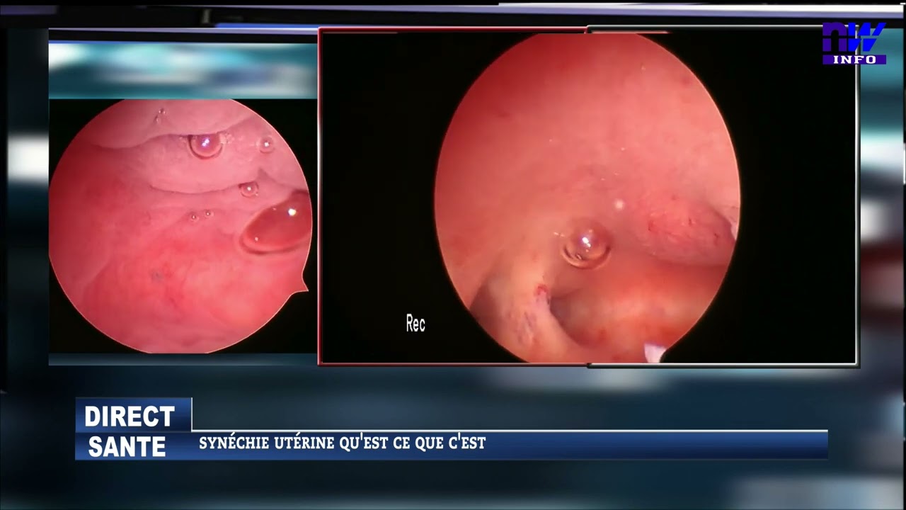 Synéchie utérine qu'est-ce que c'est P2