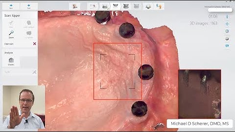 How to Scan Intraoral Scanning Edentulous Ridges using LOCATOR Housings