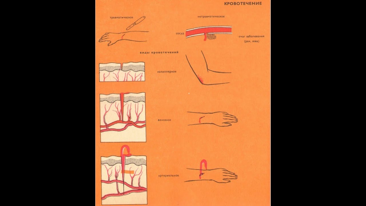 Кровотечение бывают следующих. Кровотечение схема. Виды кровотечений картинки.