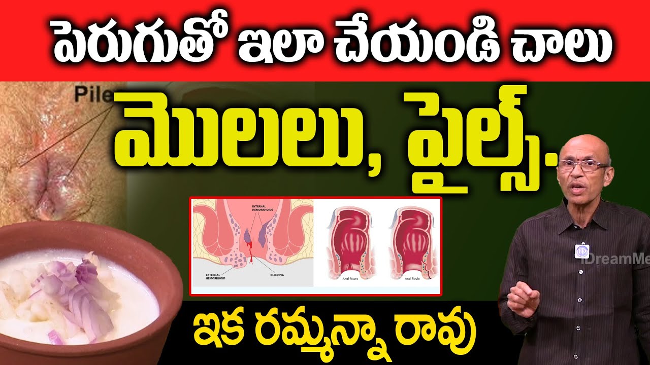 రెండు స్పూన్లు చాలు మొలలు శాశ్వతంగా మాయం | eliminate the warts forever | Dr. Madhusudhan Sharma
