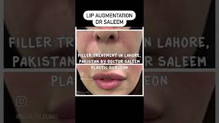 Lip augmentation in Pakistan with fillers by dr Saleem