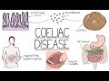 Understanding Coeliac Disease