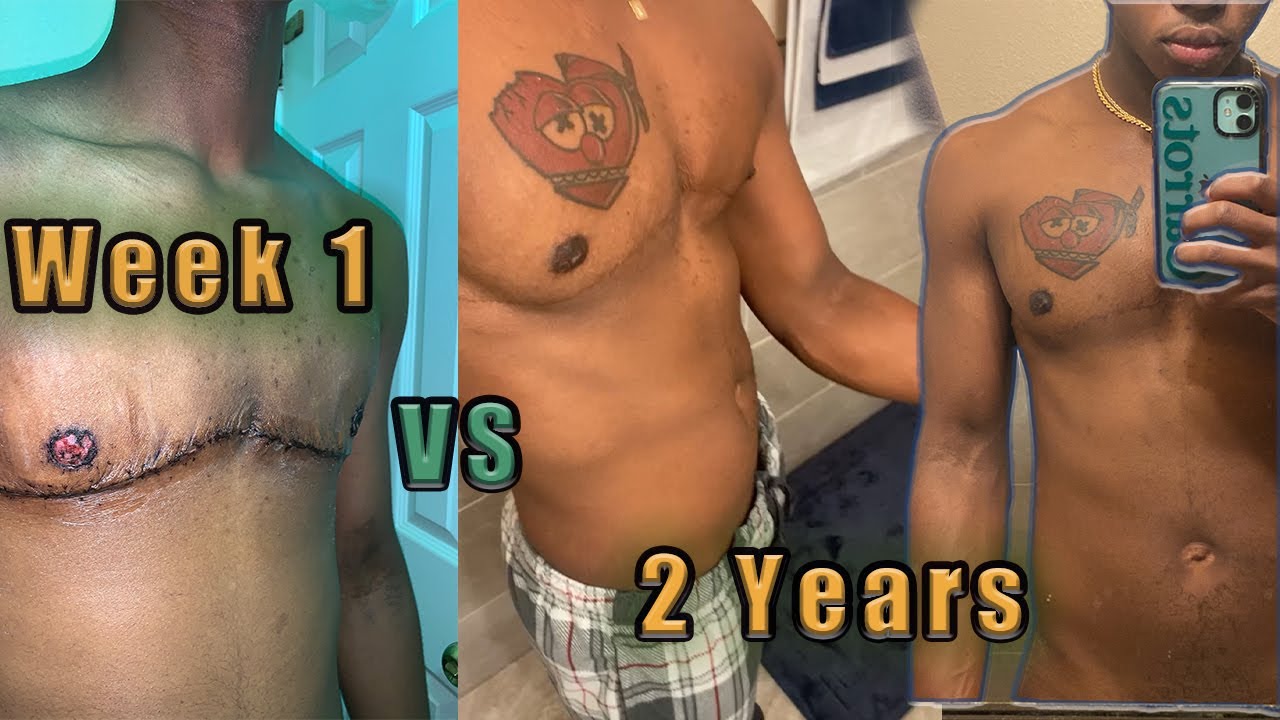 2 Years Post Op Top Surgery Black & Trans YouTube