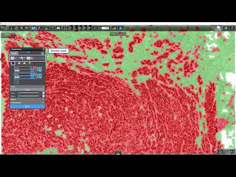 3DHISTECH - Breast Cancer Tissue Analysis using PatternQuant and NuclearQuant