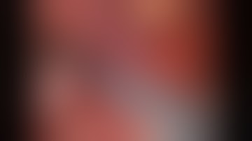 Robot-assisted intracorporeal ileal neobladder Step 1: transposition of left ureter