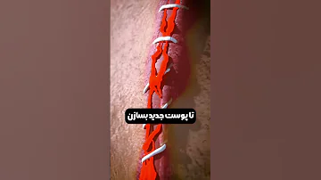 بخیه چطور کار میکنه Shorts 