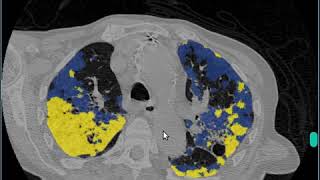 Covid-19 CT segmentation online