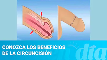 ¿Cuáles son los 3 beneficios de la circuncisión?