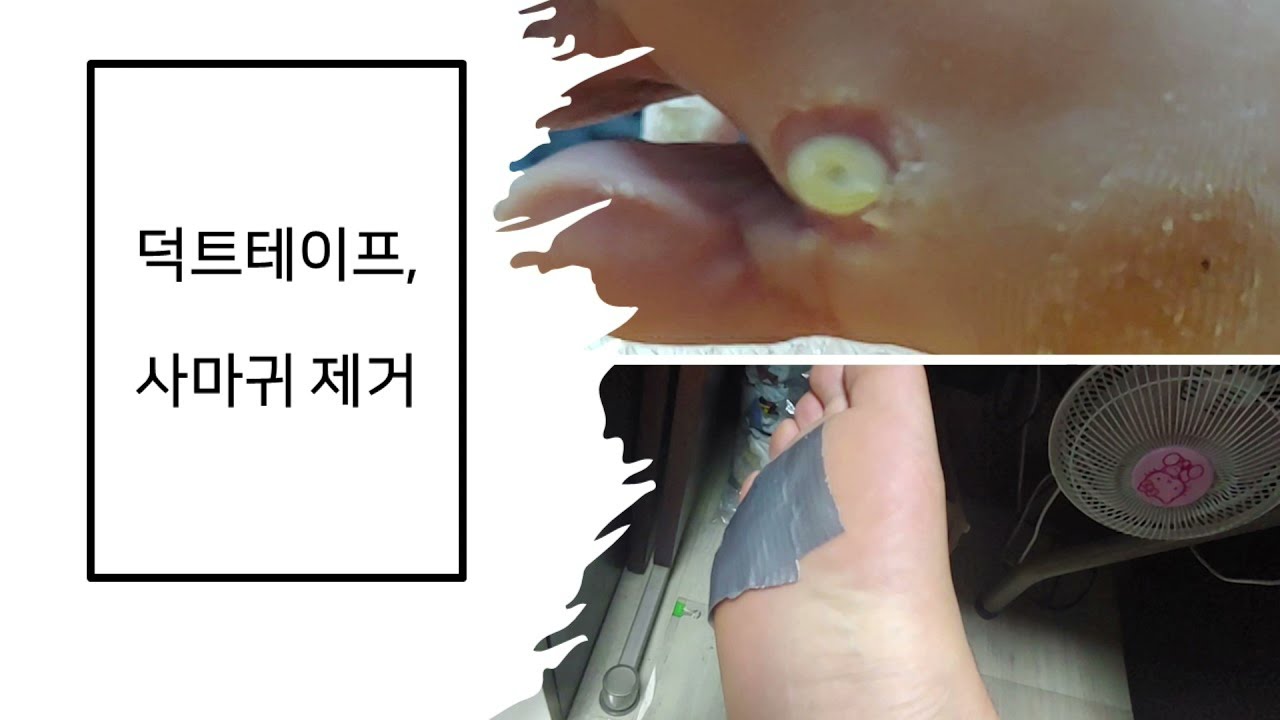 덕트테이프와 사마귀 제거, duct_tape and wart YouTube
