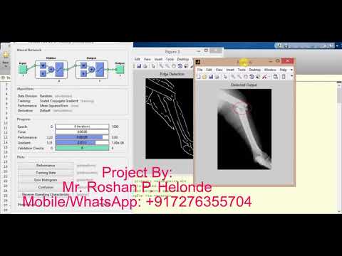 Matlab Code for Bone Fracture Detection using Neural Network