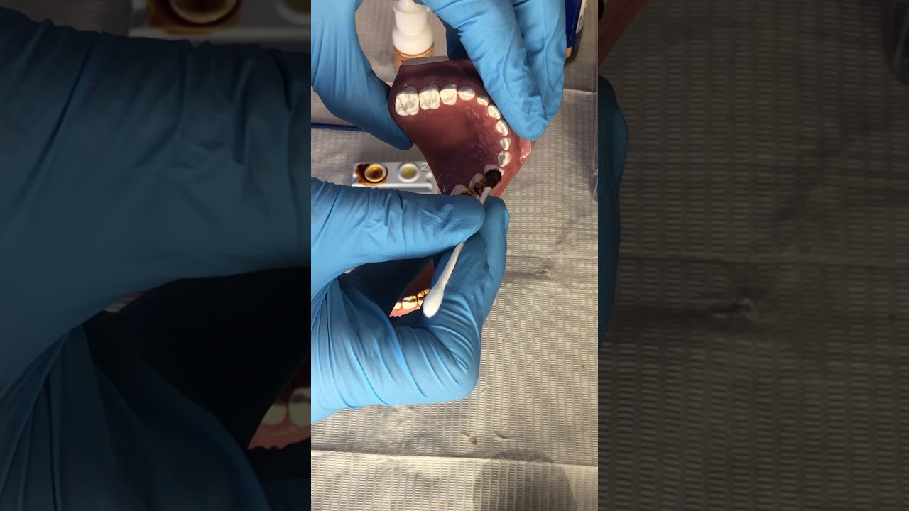 How to apply Povidone Iodine to teeth YouTube
