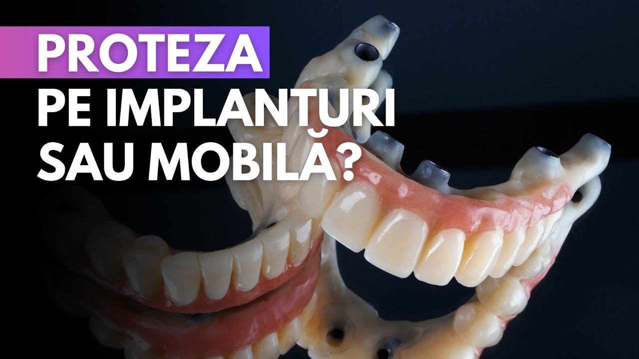 Proteza dentară pe implanturi vs. proteza dentară mobilă: Recomandări de la Dr. Gabriel Leuștean