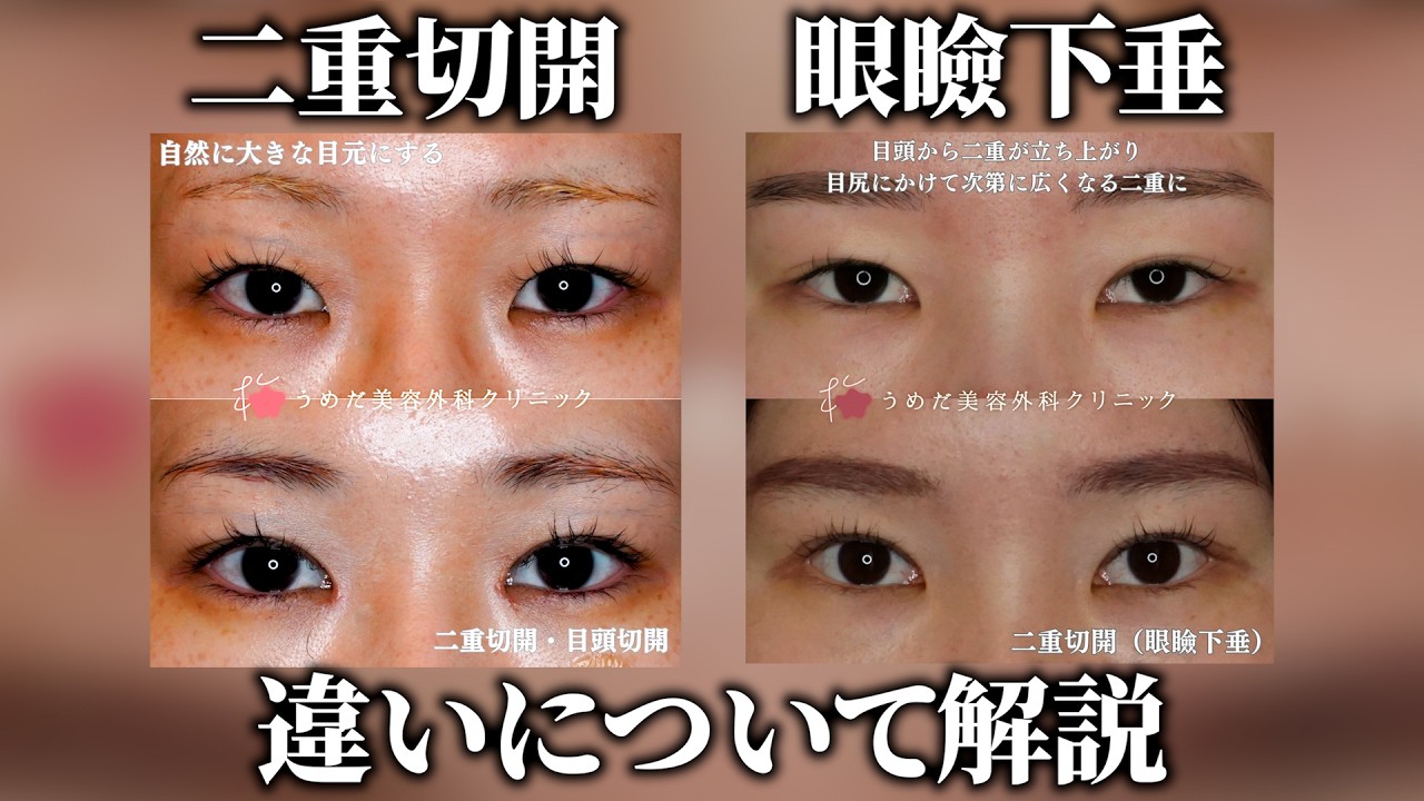 二重切開と眼瞼下垂の違いについて解説