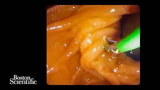 ERCP in periampullary diverticulum using the Exalt single-use duodenoscope