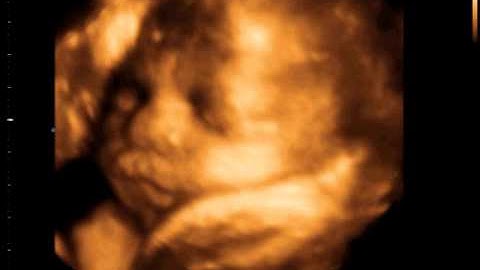 3D 4D Ultrasound NYC at 32w by 1st Glimpse Inc. 3D/4D Ultrasound