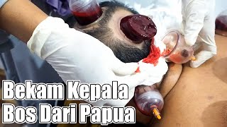 Bekam Bos Papua| Sulit Tidur Malah ketiduran saat Bekam
