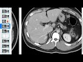 Abdomen I Parte 1-  CECiM - Fmed UBA