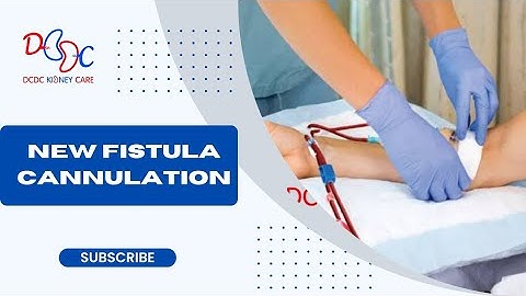 New fistula cannulation in dialysis | AVF cannulation #dcdc #dialysis #ttt #nabh
