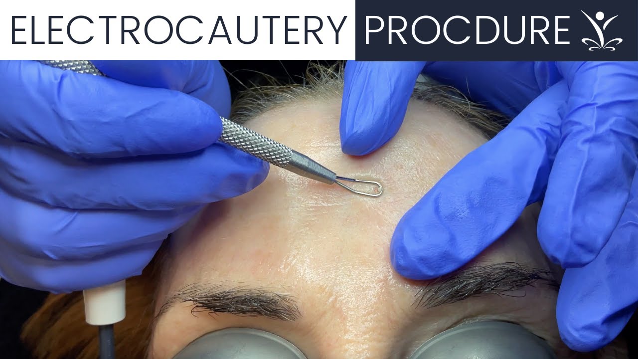 Watch an Electrocautery Procedure 