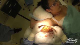 Arm Lift & Laser Smart Liposuction in Huntington Long Island NY by Dr. Lebowitz
