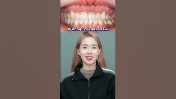 Tháo niềng xinh rạng ngời sau 2 năm niềng răng tại Nha Khoa No1 Đà Nẵng