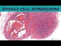 Spindle Cell Hemangioma 101