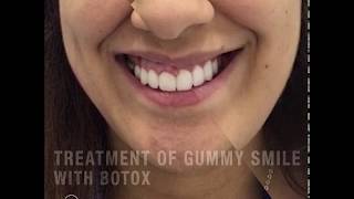 Treatment of Gummy Smile -  علاج الابتسامة اللثوية