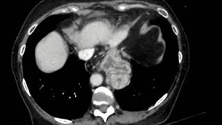 Hiatal hernia