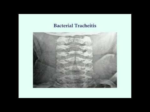 Video: Tracheitis - Behandling Af Tracheitis Med Alternative Metoder Og Midler