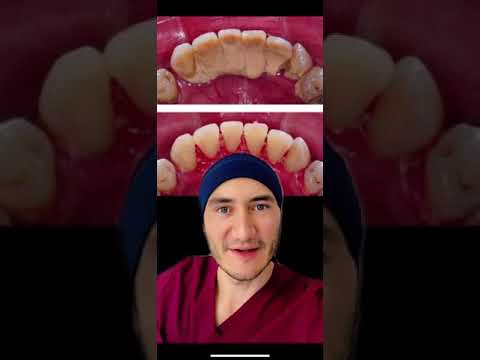 Huecos entre los dientes despues de una limpieza