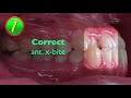 【Chris Chang Ortho】438. Correcting Anterior Crossbite for Patients with Extraction Space