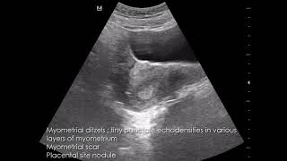 CASE 950 Myometrial ditzels