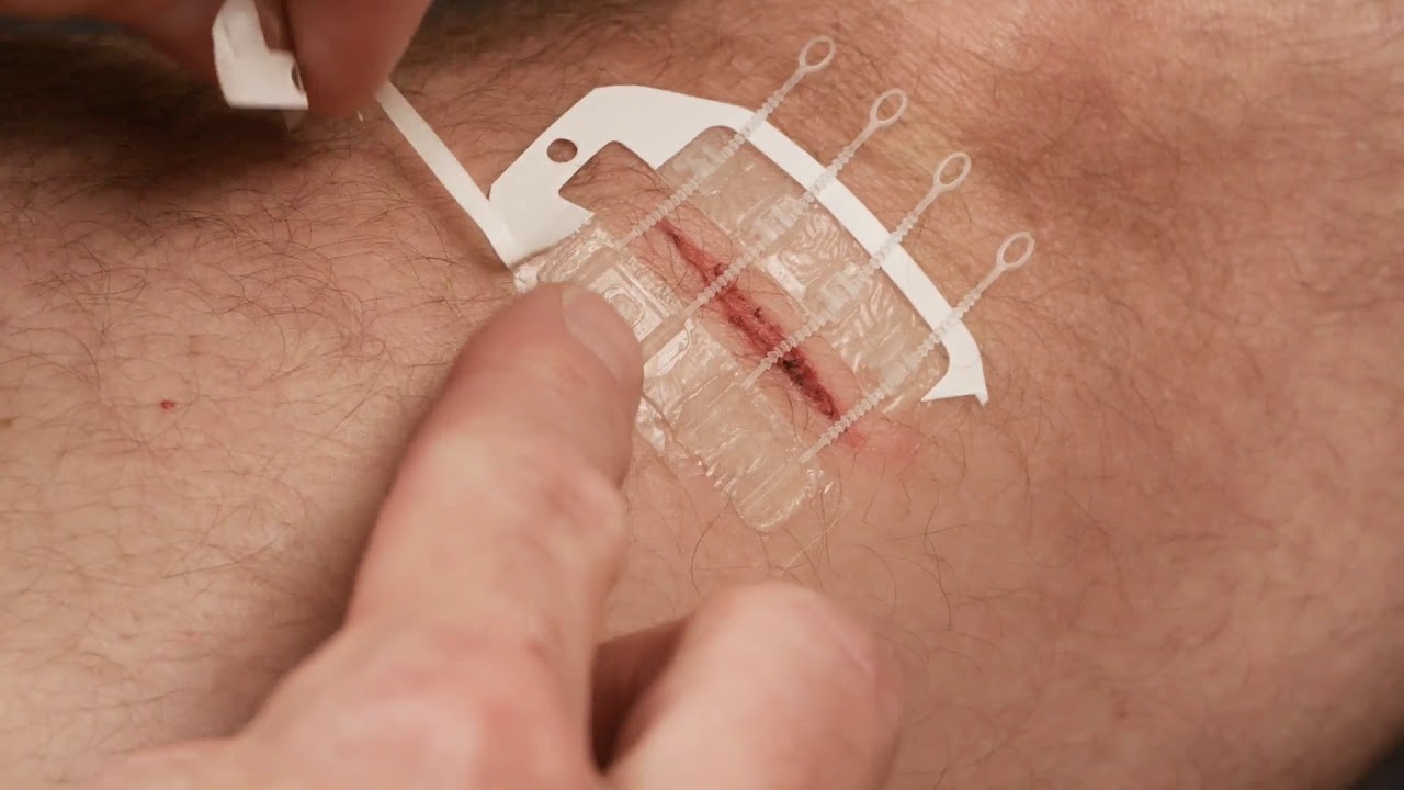 誰でも簡単に 縫合が必要なレベルの切り傷 に応急処置を施せる Zipstitch Gigazine