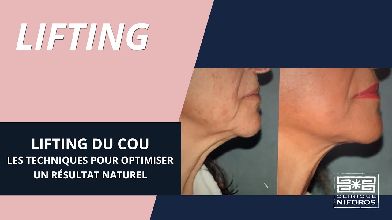Lifting du cou : les solutions pour optimiser un résultat naturel - Dr Niforos à Lyon