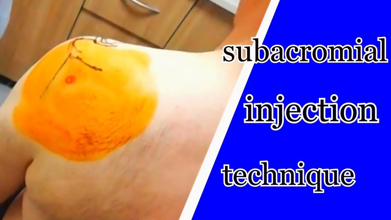 Real Shoulder Steroid Injection Posterior Dr. Kemal Gokkus YouTube
