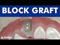 Dental bone graft for implants - Block Bone grafting ©