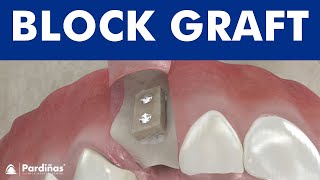 Dental bone graft for implants  Block Bone grafting ©