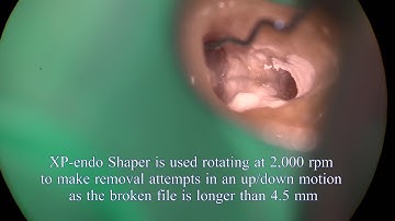 Non-visible broken file removal with TFRK-12 and XP-Endo Shaper
