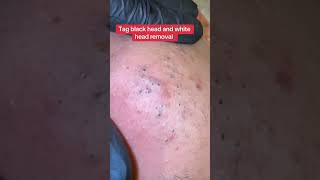 Soon new video remove black head