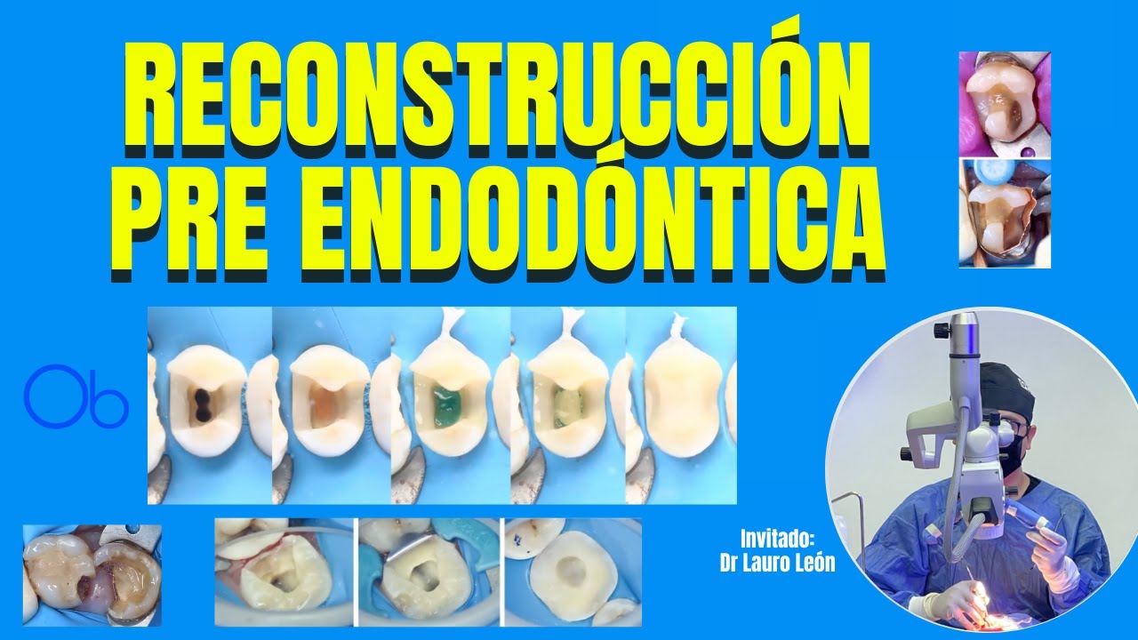 Reconstrucción Pre Endodóntica 🦷 con Dr Lauro León