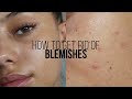 HOW TO GET RID OF BLEMISHES IN 3 DAYS | Jessicvpimentel