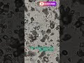uric acid crystal and erythrocyte #laboratory #viralshorts  #trendshort  #tseries  #healthylifestyle