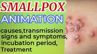 Smallpox symptoms | smallpox treatment | small pox | smallpox animation | smallpox virus | 3D