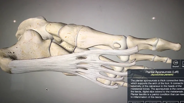 Plantar fasciitis Video