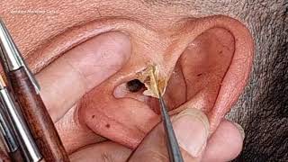 Cara membersihkan kotoran telinga yang kering (CT5)