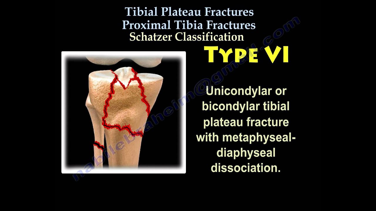 Tibial Plateau Fractures Physiopedia