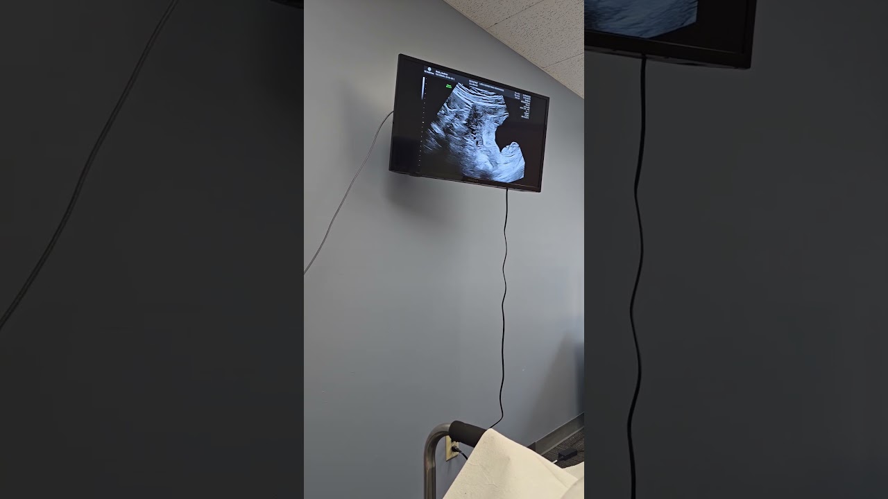 9 week baby ultrasound.