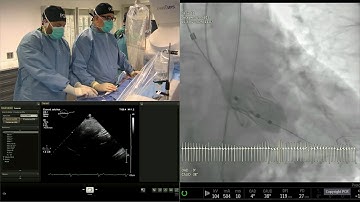 Align for the future with next gen Myval transcatheter heart valve series - PCR London Valves 2025