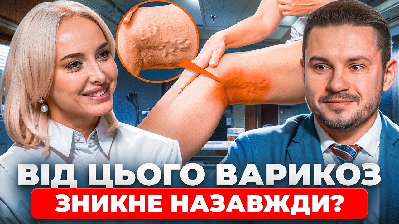 Як ВИЛІКУВАТИ варикоз БЕЗ ОПЕРАЦІЇ? Від чого виникає СУДИННА сітка. Як РОЗПІЗНАТИ проблеми з венами?