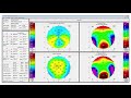 Oculus pentacam axl demo at aao 2017